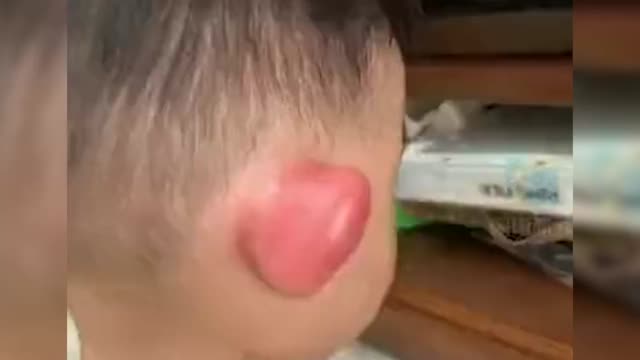 萌娃耳朵被蚊虫叮咬，肿成“大耳朵图图”